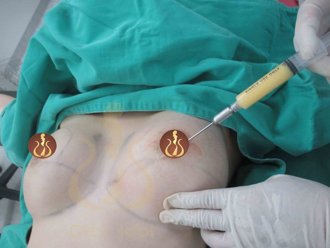 左 外 右 內 完 成 局 部 麻 醉 互 動 式 站 立 抽 脂 及 局 部 麻 醉 自 體 脂 肪 注 射