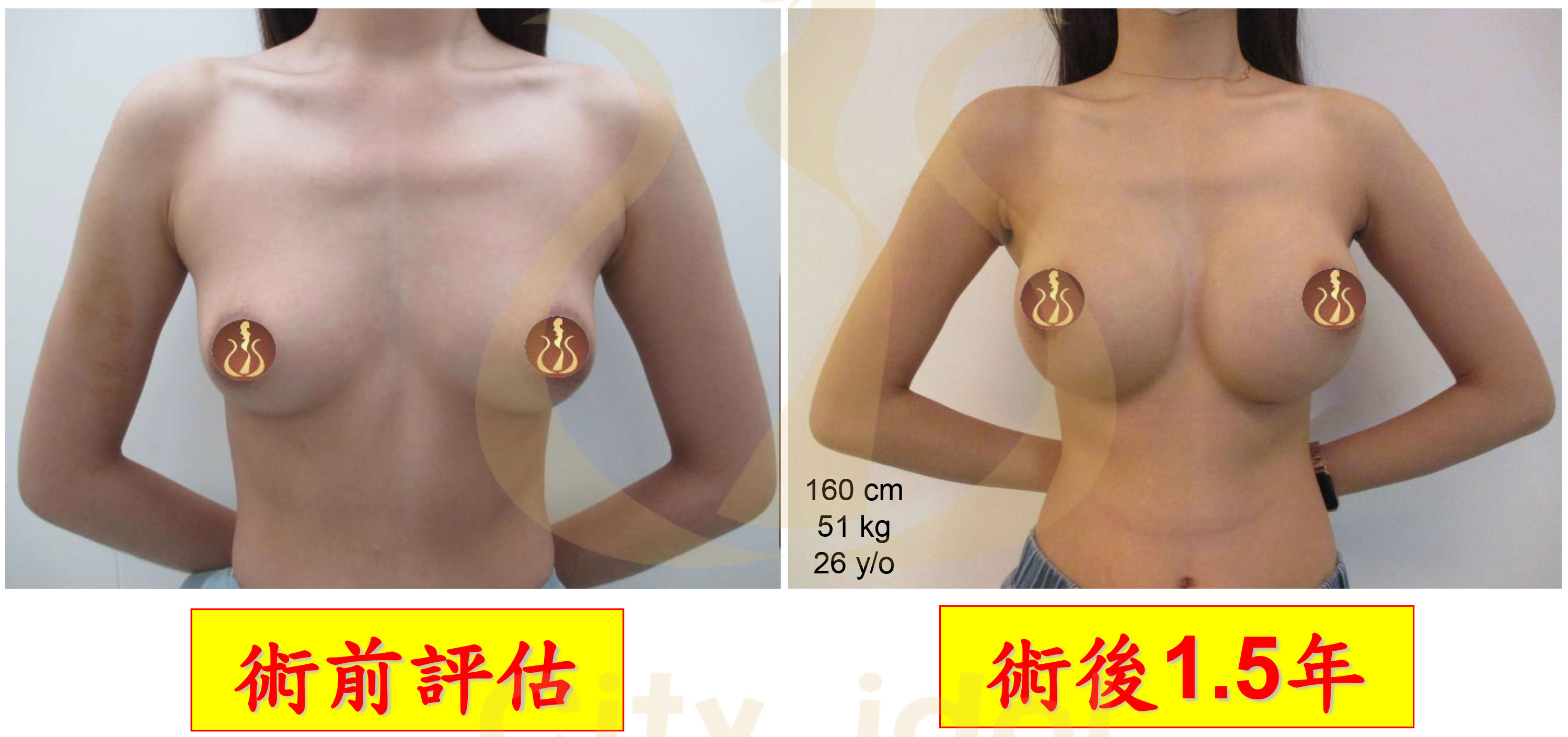 Mentor曼陀水滴術前及術後1.5年比較胸罩