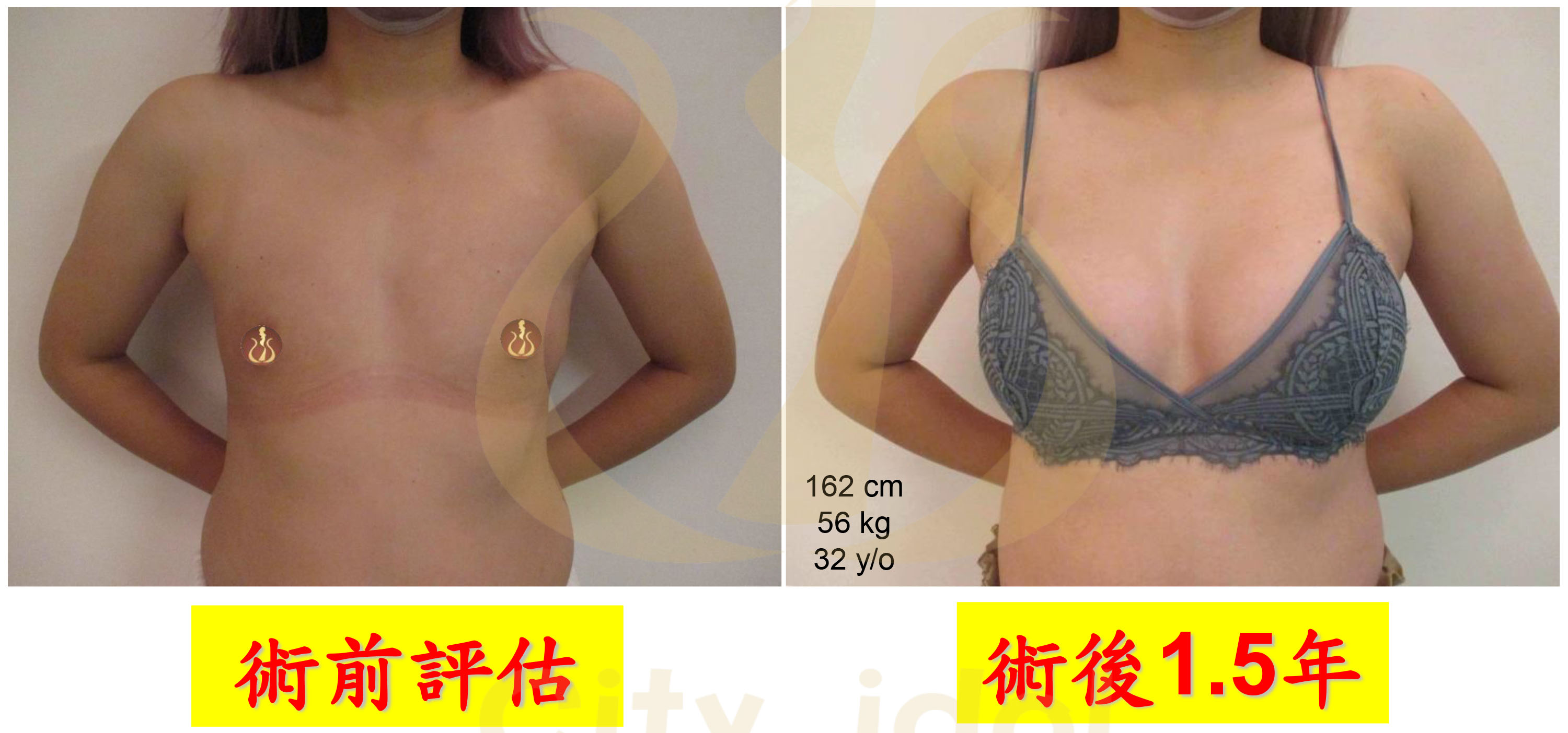 Motiva魔滴圓盤術前及術後1.5個月比較胸罩